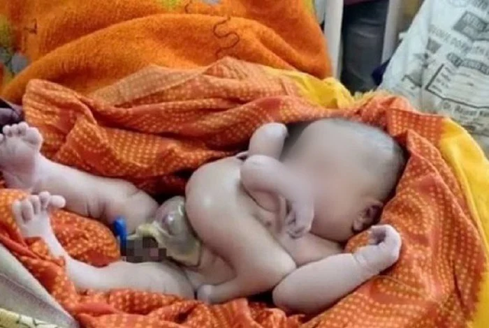 Bebê nasce com quatro braços e quatro pernas na Índia - Reprodução