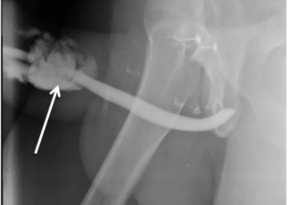 Radiografia do acidente: fraturas atingiram corpos cavernosos do pênis ?- Foto: Reprodução / International Journal of Surgery Case Reports