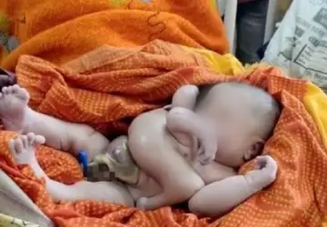Bebê nasce com quatro braços e quatro pernas na Índia - Reprodução
