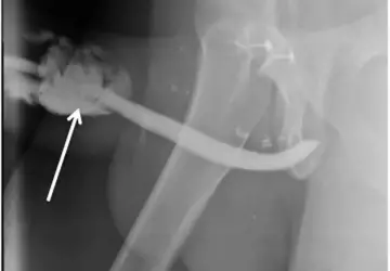 Radiografia do acidente: fraturas atingiram corpos cavernosos do pênis ?- Foto: Reprodução / International Journal of Surgery Case Reports